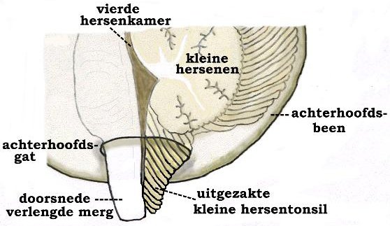 Chiari