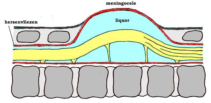 lengtedoorsnede door een meningoc�le