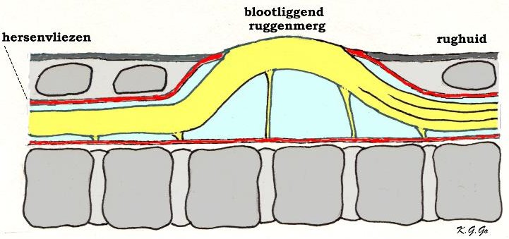 blootliggend ruggenmerg