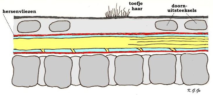 schematische lengtedoorsnede door een spina bifida occulta